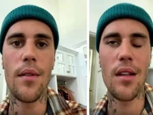 पॉप सिंगर Justin Bieber का आधा चेहरा हो गया हैं इस बीमारी से ग्रसित, मुंह से बोल पाना भी हुआ मुश्किल 2 पॉप सिंगर Justin Bieber का आधा चेहरा हो गया हैं इस बीमारी से ग्रसित, मुंह से बोल पाना भी हुआ मुश्किल