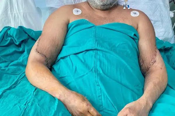 Bilateral Hand Transplant